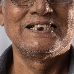 A closeup of an older man with a missing tooth