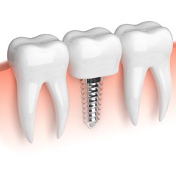 Illustration of a single dental implant in Sweeny, TX