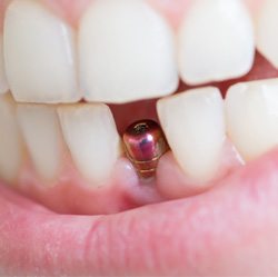 Close-up of unrestored dental implants between teeth