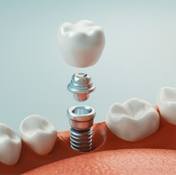 Illustration of dental crown, abutment, and dental implant being placed